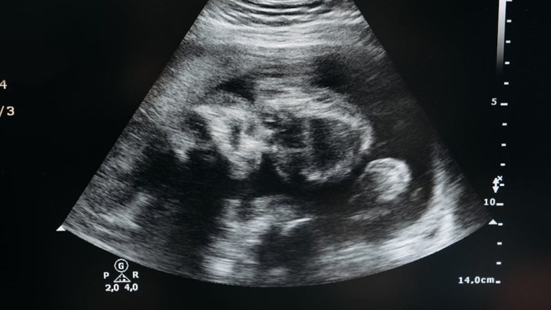 Contra aborto, Porto Rico passa a reconhecer feto como “pessoa natural” desde a concepção