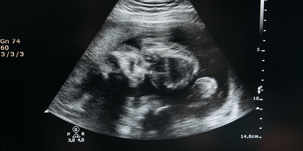 Contra aborto, Porto Rico passa a reconhecer feto como “pessoa natural” desde a concepção