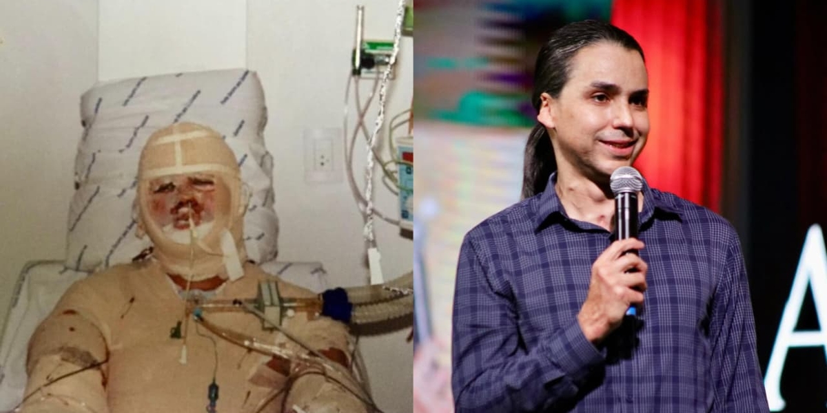 Homem desenganado com 40% do corpo queimado sobrevive: “Estou vivo para glória de Deus”